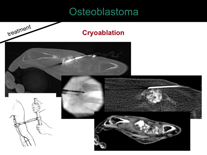 percutaneous ablation of benign bone tumors