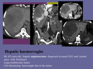 Vascular oncology emergencies managementHemorrhage in oncologic interventional radiology
