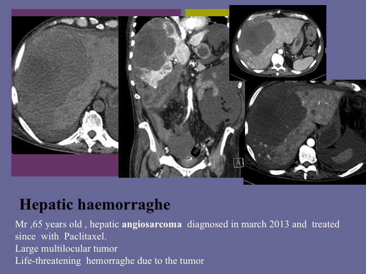 Vascular oncology emergencies managementHemorrhage in oncologic interventional radiology