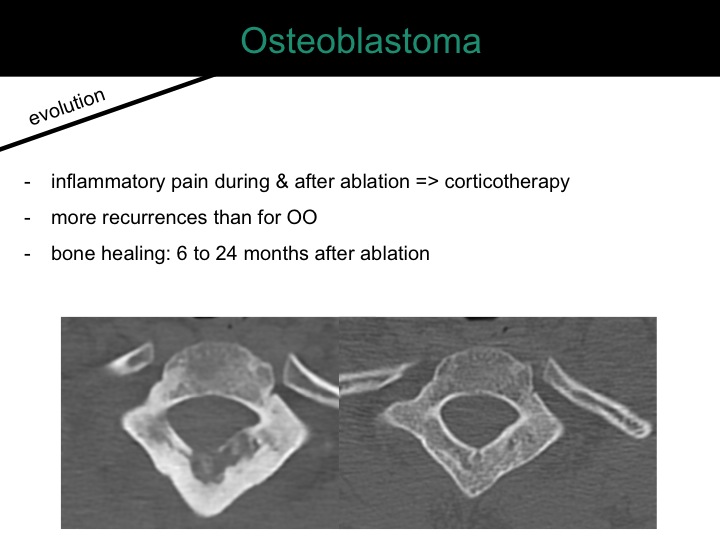 percutaneous ablation of benign bone tumors