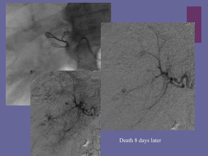 Vascular oncology emergencies managementHemorrhage in oncologic interventional radiology