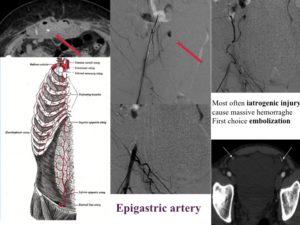 Vascular oncology emergencies managementHemorrhage in oncologic interventional radiology