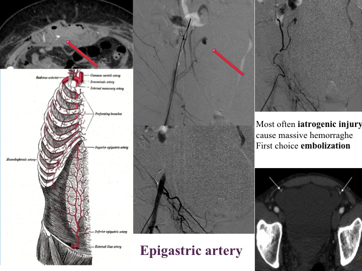 Vascular oncology emergencies managementHemorrhage in oncologic interventional radiology