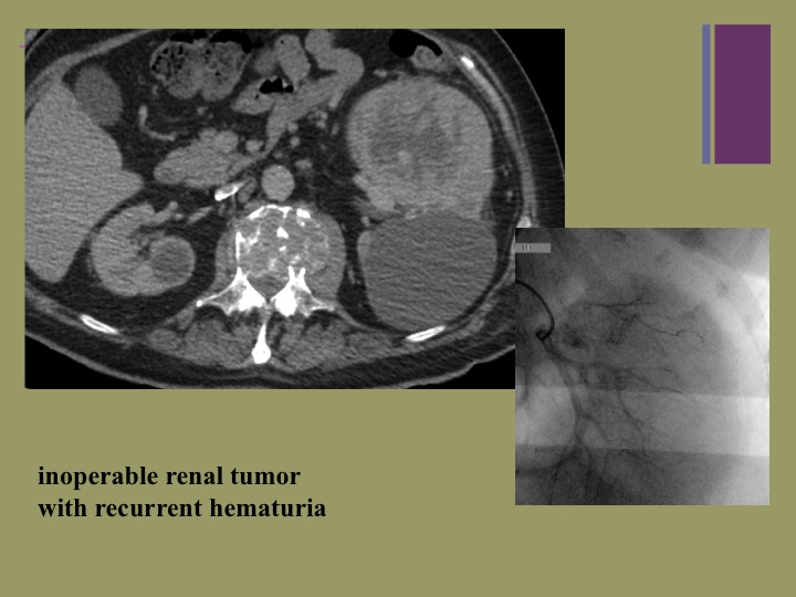 Vascular oncology emergencies managementHemorrhage in oncologic interventional radiology