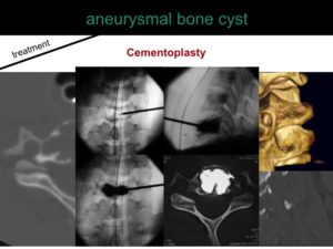 percutaneous ablation of benign bone tumors