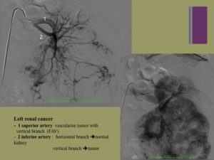 Vascular oncology emergencies managementHemorrhage in oncologic interventional radiology