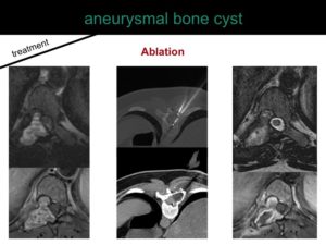 percutaneous ablation of benign bone tumors