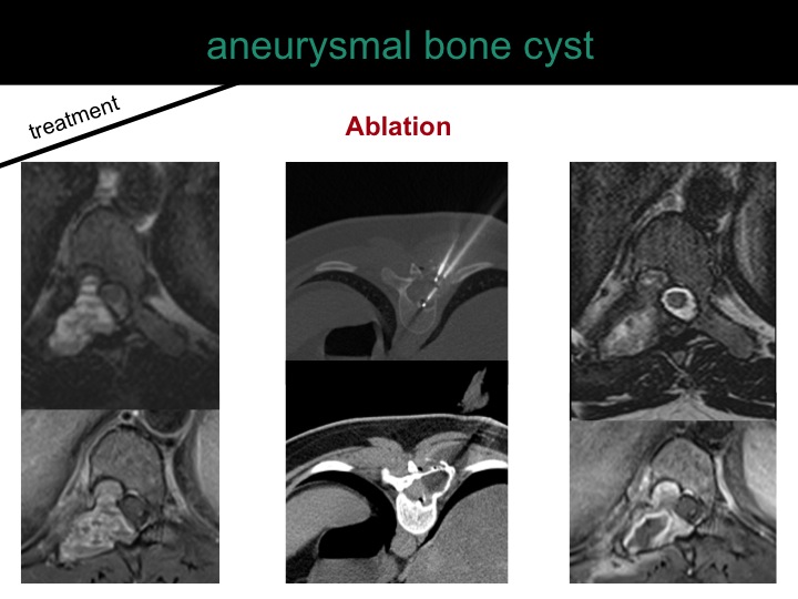 percutaneous ablation of benign bone tumors