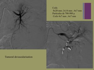 Vascular oncology emergencies managementHemorrhage in oncologic interventional radiology