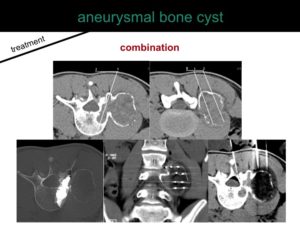 percutaneous ablation of benign bone tumors