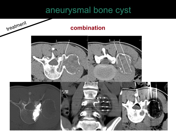 percutaneous ablation of benign bone tumors