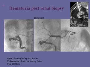 Vascular oncology emergencies managementHemorrhage in oncologic interventional radiology