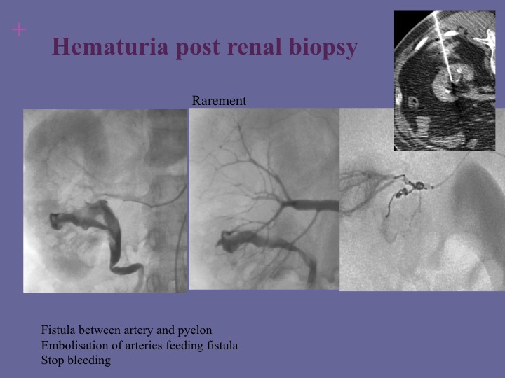 Vascular oncology emergencies managementHemorrhage in oncologic interventional radiology