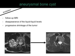 percutaneous ablation of benign bone tumors