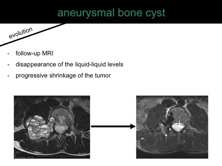 percutaneous ablation of benign bone tumors