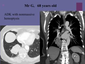 Vascular oncology emergencies managementHemorrhage in oncologic interventional radiology