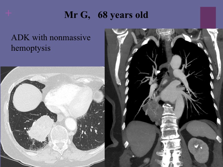 Vascular oncology emergencies managementHemorrhage in oncologic interventional radiology