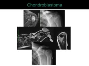 percutaneous ablation of benign bone tumors