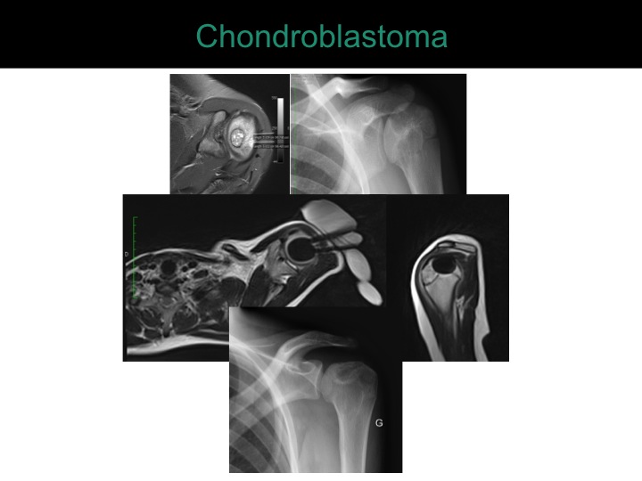 percutaneous ablation of benign bone tumors
