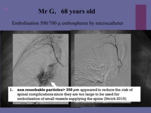 Vascular oncology emergencies managementHemorrhage in oncologic interventional radiology