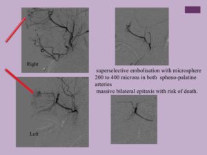 Vascular oncology emergencies managementHemorrhage in oncologic interventional radiology