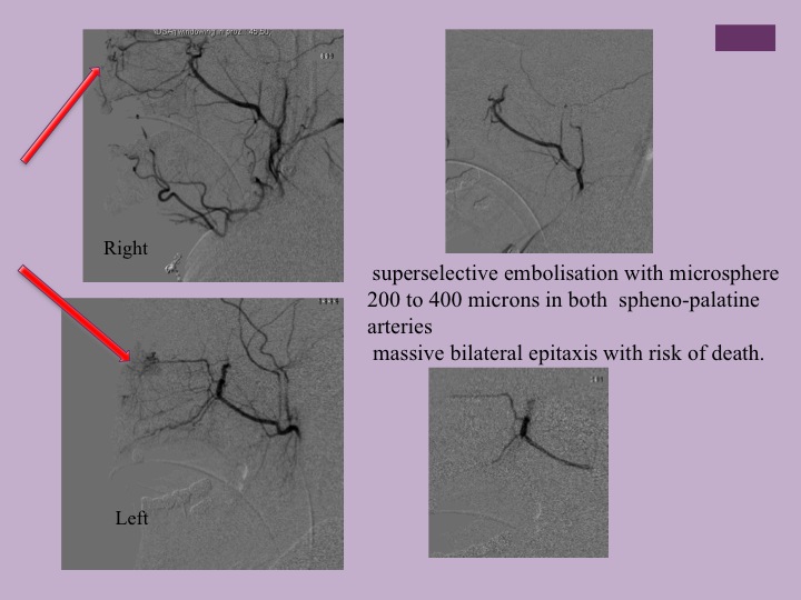 Vascular oncology emergencies managementHemorrhage in oncologic interventional radiology