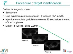 Breast MRI Interventional JFIM Mumbai 2016