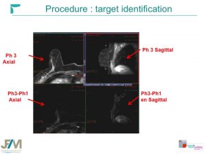 Breast MRI Interventional JFIM Mumbai 2016