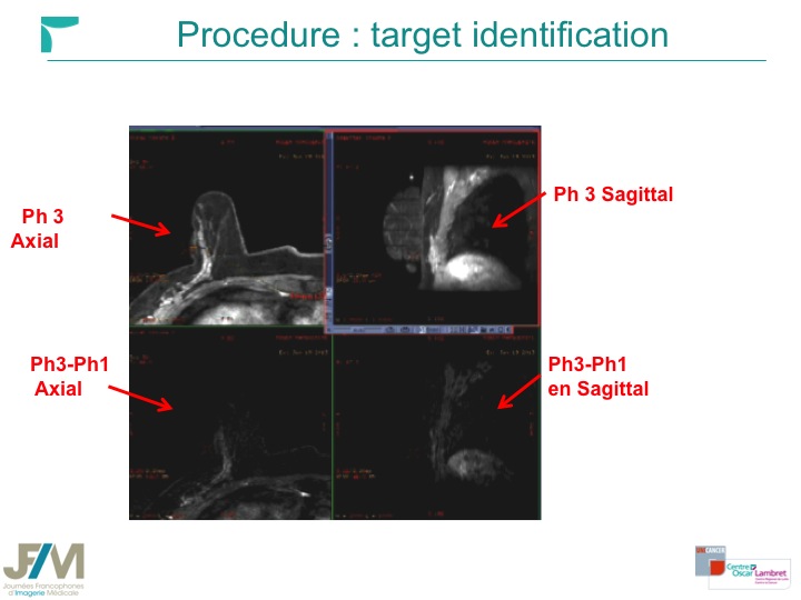Breast MRI Interventional JFIM Mumbai 2016