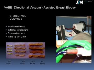 Breast Open Surgery without prior Biopsy : Still Available?