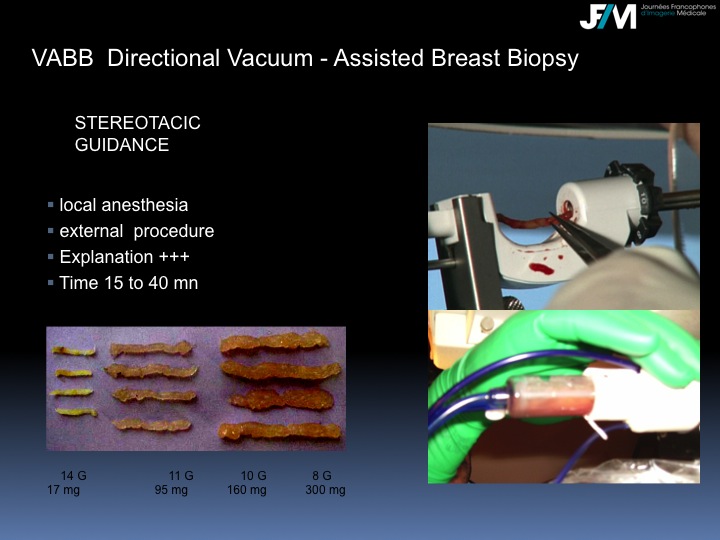 Breast Open Surgery without prior Biopsy : Still Available?