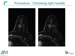 Breast MRI Interventional JFIM Mumbai 2016