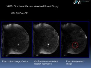 Breast Open Surgery without prior Biopsy : Still Available?