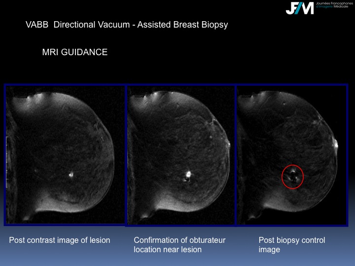 Breast Open Surgery without prior Biopsy : Still Available?
