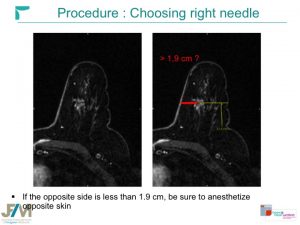 Breast MRI Interventional JFIM Mumbai 2016