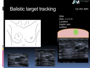 Breast Open Surgery without prior Biopsy : Still Available?