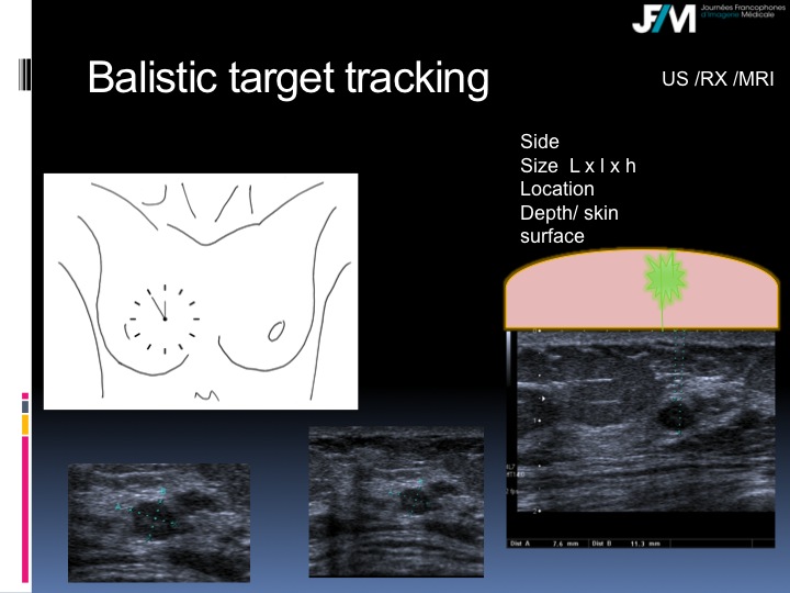 Breast Open Surgery without prior Biopsy : Still Available?