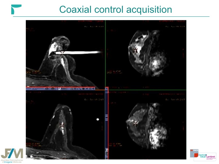 Breast MRI Interventional JFIM Mumbai 2016