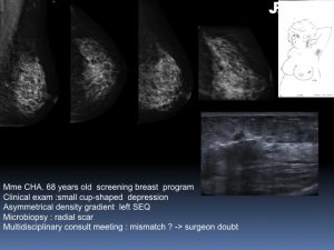 Breast Open Surgery without prior Biopsy : Still Available?
