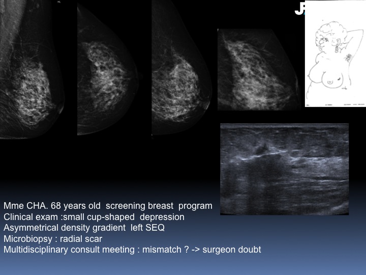 Breast Open Surgery without prior Biopsy : Still Available?