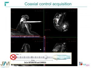 Breast MRI Interventional JFIM Mumbai 2016