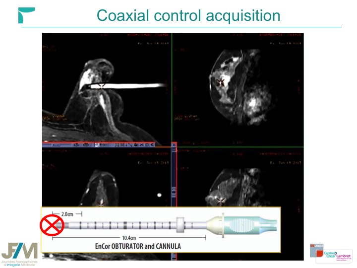 Breast MRI Interventional JFIM Mumbai 2016