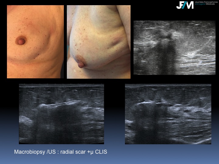 Breast Open Surgery without prior Biopsy : Still Available?
