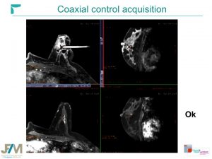 Breast MRI Interventional JFIM Mumbai 2016