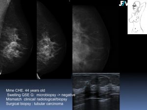 Breast Open Surgery without prior Biopsy : Still Available?