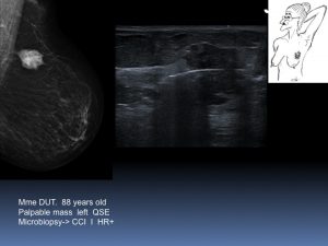 Breast Open Surgery without prior Biopsy : Still Available?