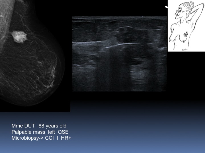 Breast Open Surgery without prior Biopsy : Still Available?