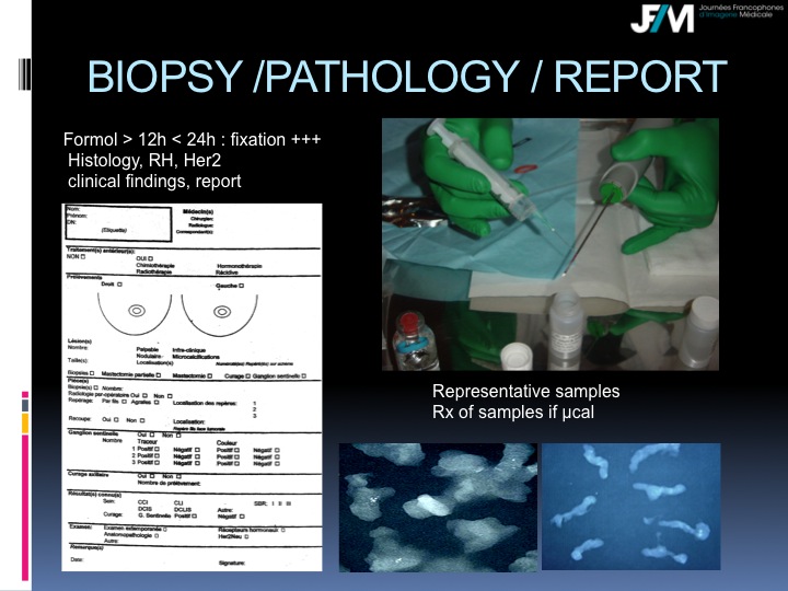 Breast Open Surgery without prior Biopsy : Still Available?