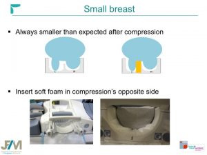 Breast MRI Interventional JFIM Mumbai 2016