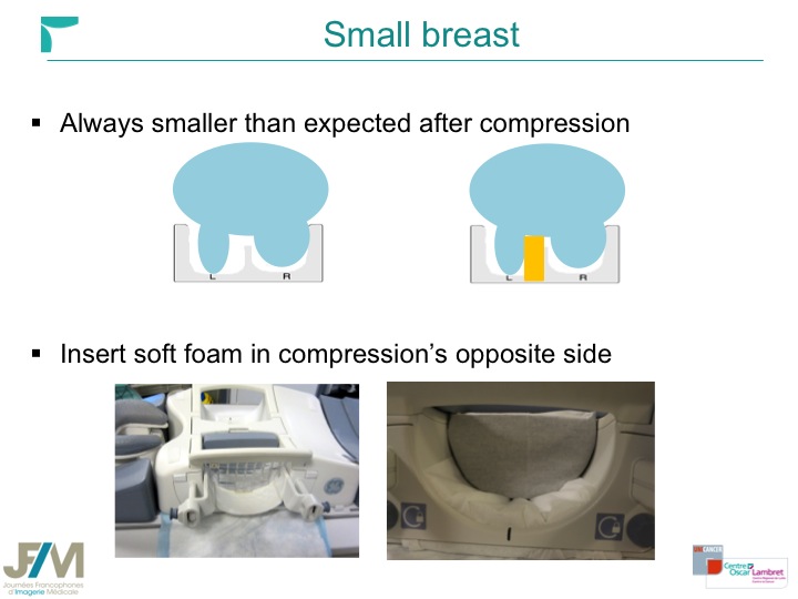 Breast MRI Interventional JFIM Mumbai 2016